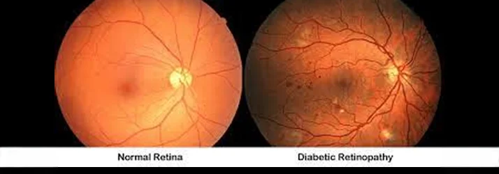 Eye Doctor East Brunswick NJ Diabetic Eye Scan